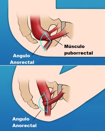 evacuar mejor Angulo anorectal