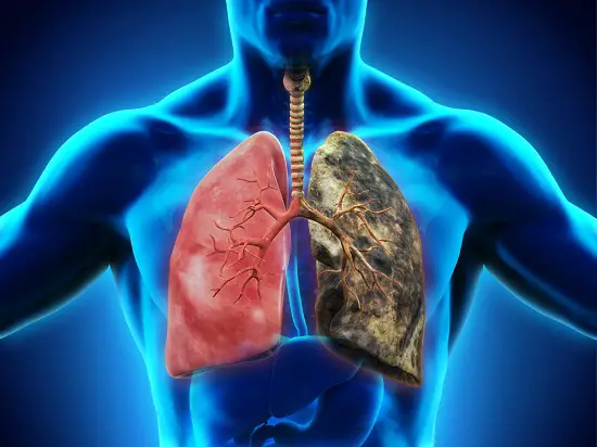 gráfico de bronquitis